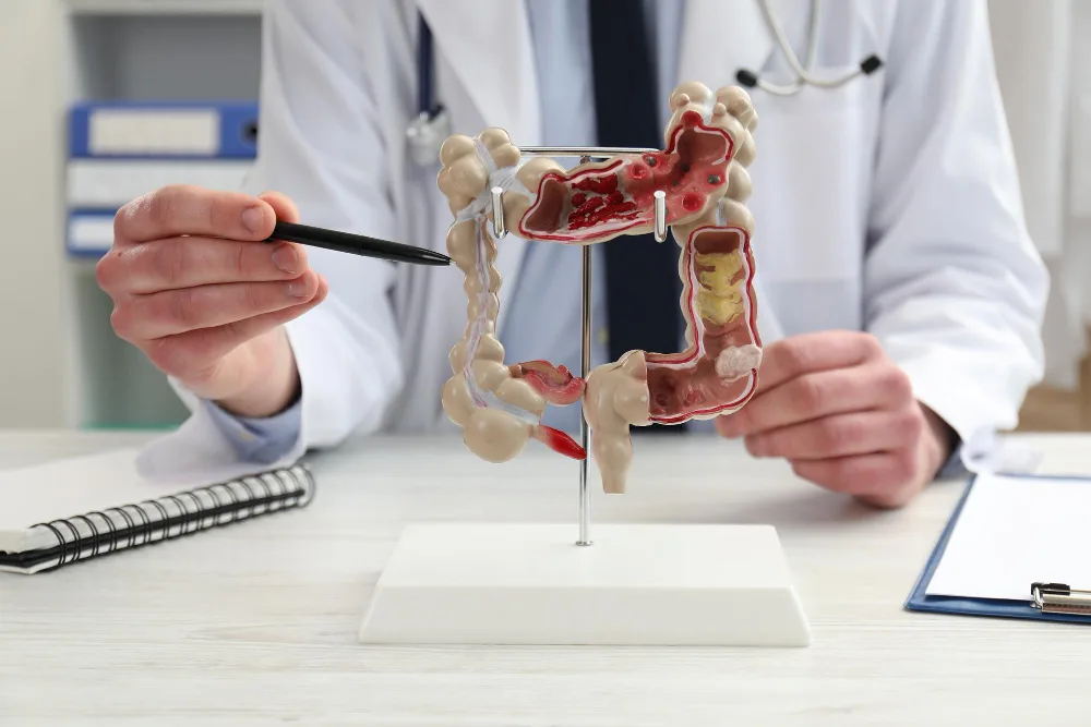Divertículos colónicos en Querétaro: entender las bolsas del colon y cuándo vigilarlas