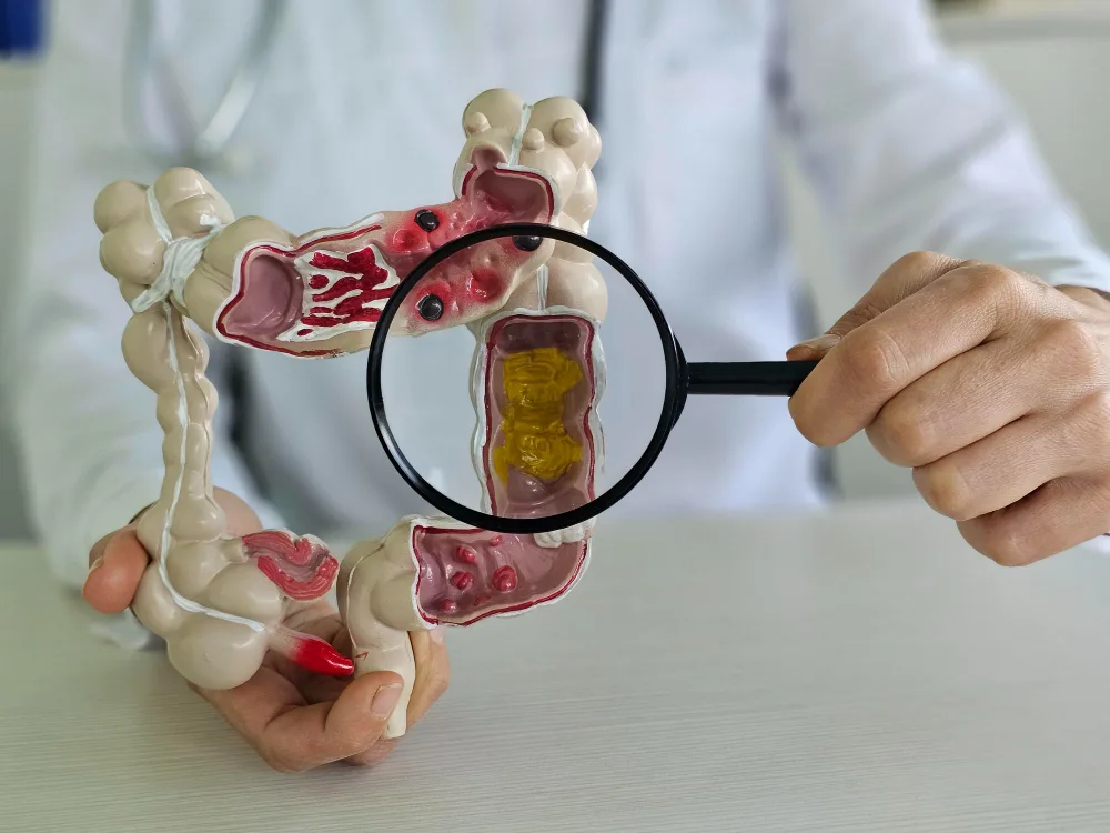 Enfermedad de Crohn y CUCI en Querétaro: seguimiento de la enfermedad inflamatoria intestinal